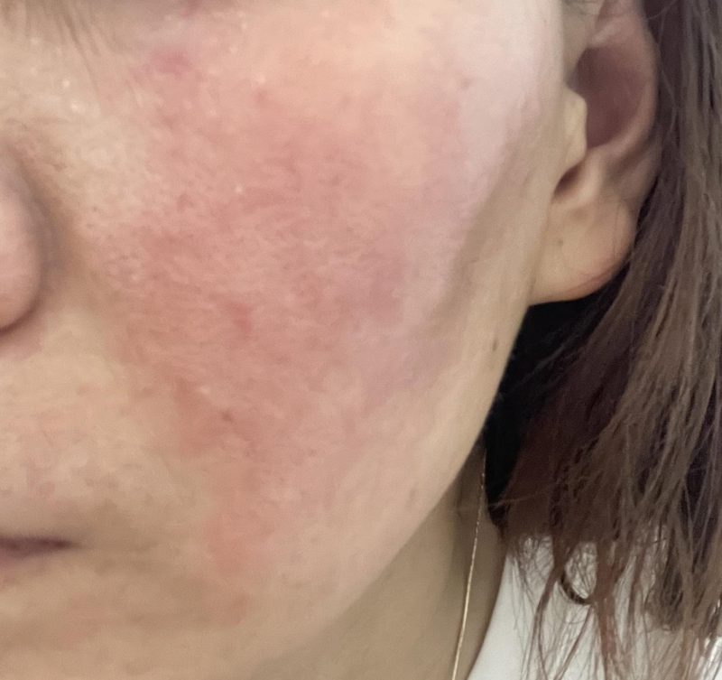 Liệu Trình Phục Hồi Da Nhiễm Corticoid Bao Gồm Những Gì?
