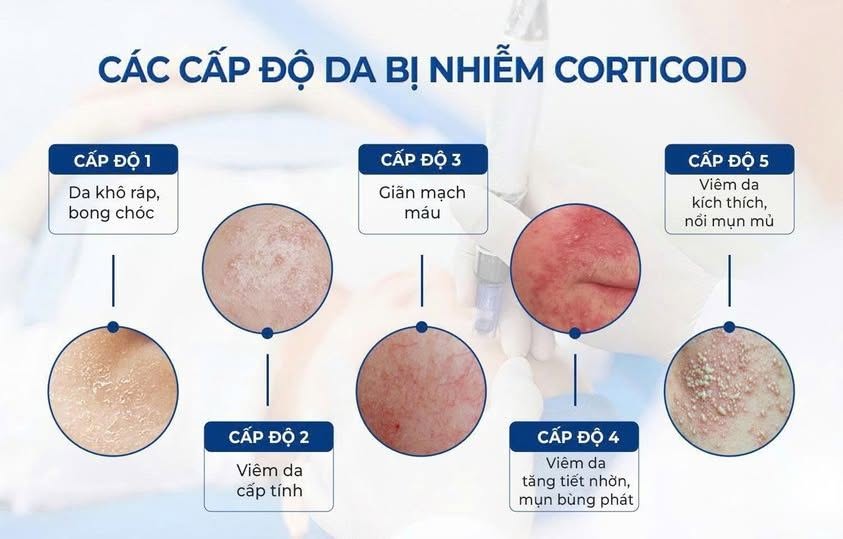 Liệu Trình Phục Hồi Da Nhiễm Corticoid Bao Gồm Những Gì?
