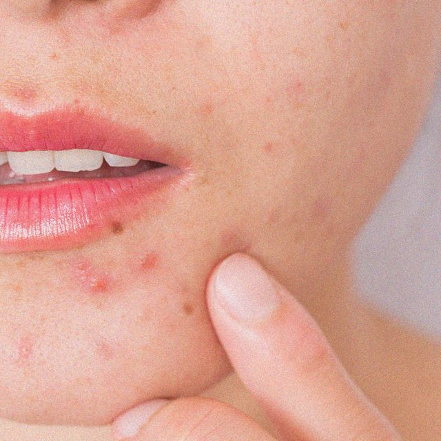 Mụn Ở Cằm Báo Hiệu Điều Gì