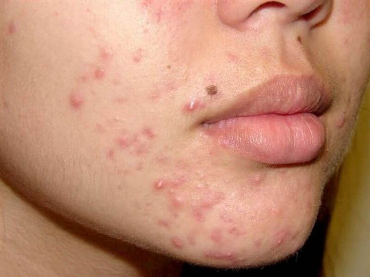 Mụn Ở Cằm Báo Hiệu Điều Gì