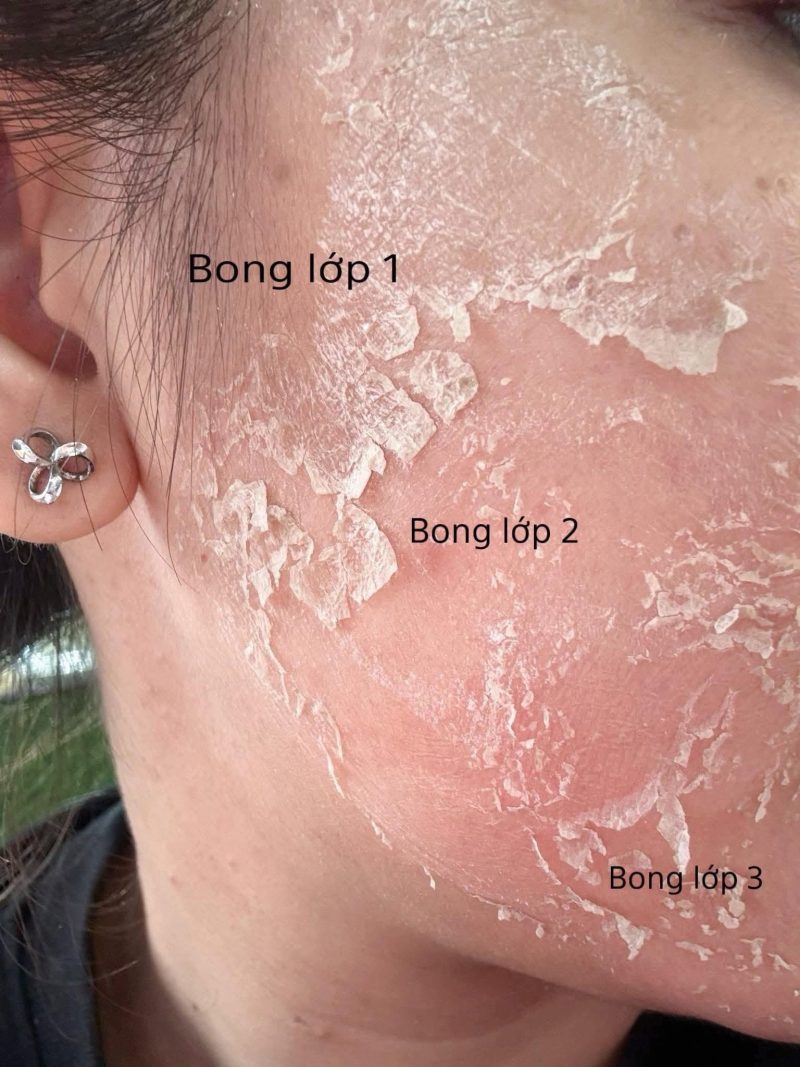 Peel Nông, Peel Trung Bình Và Peel Sâu Khác Nhau Thế Nào