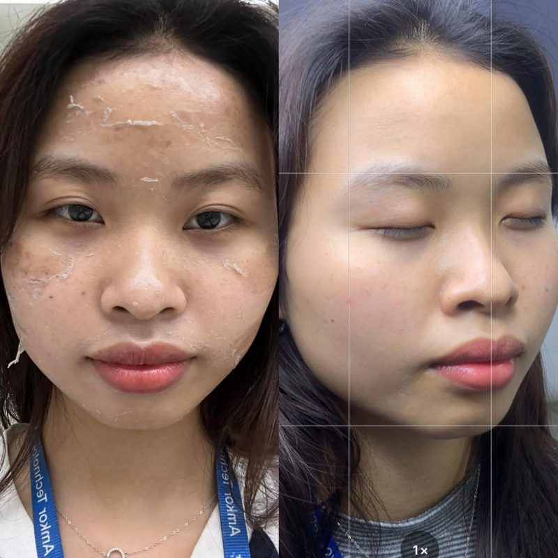 Peel Nông, Peel Trung Bình Và Peel Sâu Khác Nhau Thế Nào