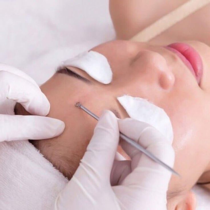 Spa Hay Phòng Khám Da Liễu Khi Lấy Nhân Mụn