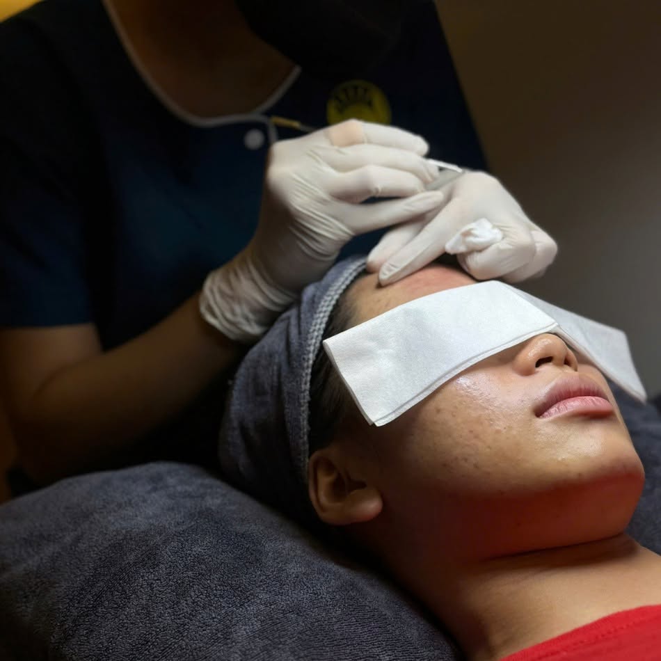 Vai Trò Của Lấy Nhân Mụn Trong Điều Trị Mụn Chuyên Sâu