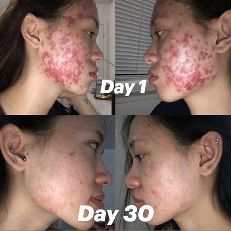 Vai Trò Của Lấy Nhân Mụn Trong Điều Trị Mụn Chuyên Sâu