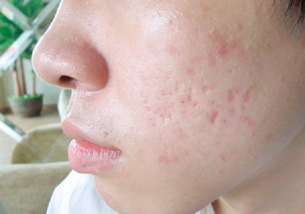 Vì Sao Điều Trị Sẹo Mụn Cần Kiên Trì?