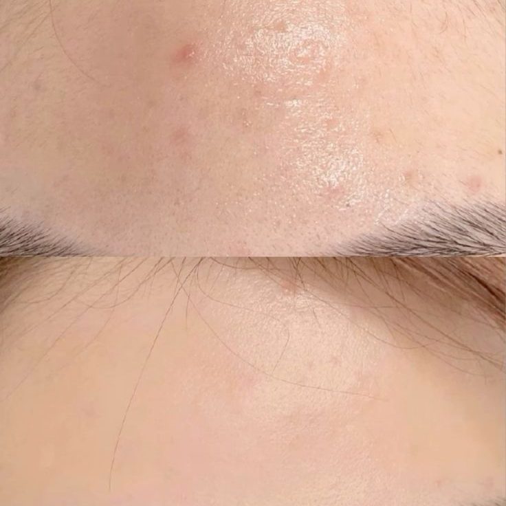Vì Sao Mụn Ẩn Cần Được Lấy Nhân Đúng Thời Điểm